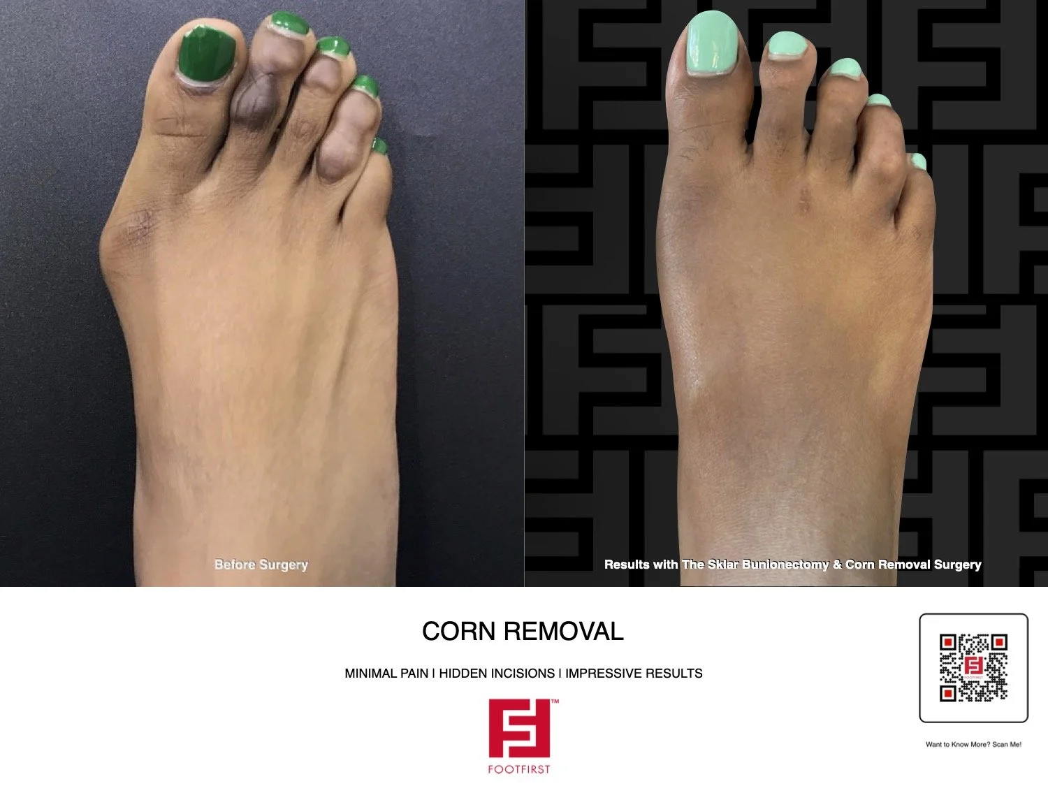 Minimally Invasive Corn Removal Surgery At Foot First Podiatry Foot minimally-invasive-corn-removal-surgery-at-foot-first-podiatry-foot